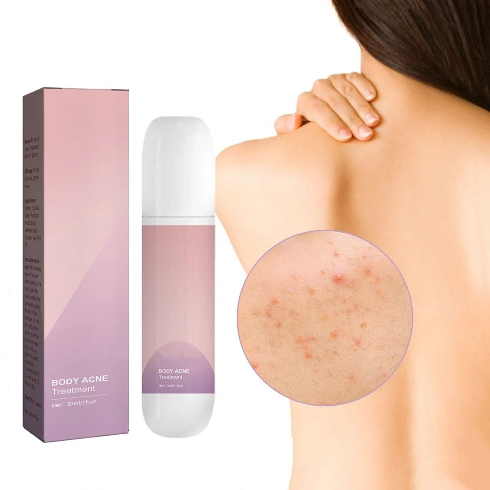 Acne Ball 30ml treatment with 13.3cm applicator for back and chest acne
