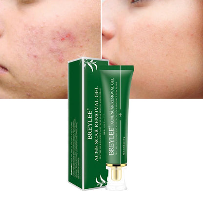 Tea Tree Acne Scar Removal Gel with Qu Dou Printing, 30g tube