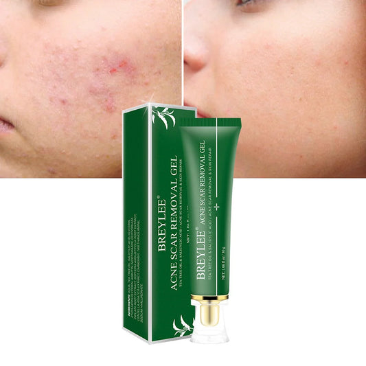 Tea Tree Acne Scar Removal Gel with Qu Dou Printing, 30g tube