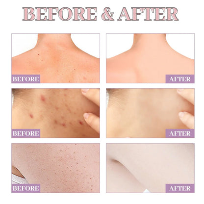 Acne Ball 30ml treatment with 13.3cm applicator for back and chest acne