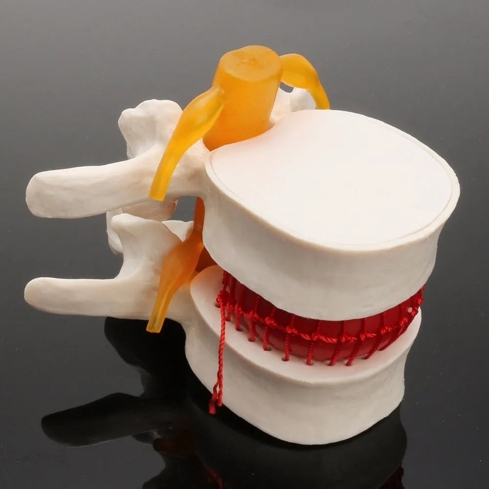 White PVC lumbar intervertebral disc demonstration model for medical education