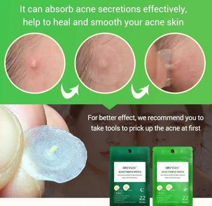 Tea Tree Acne Patch ultra-thin design for fading acne marks and blemishes