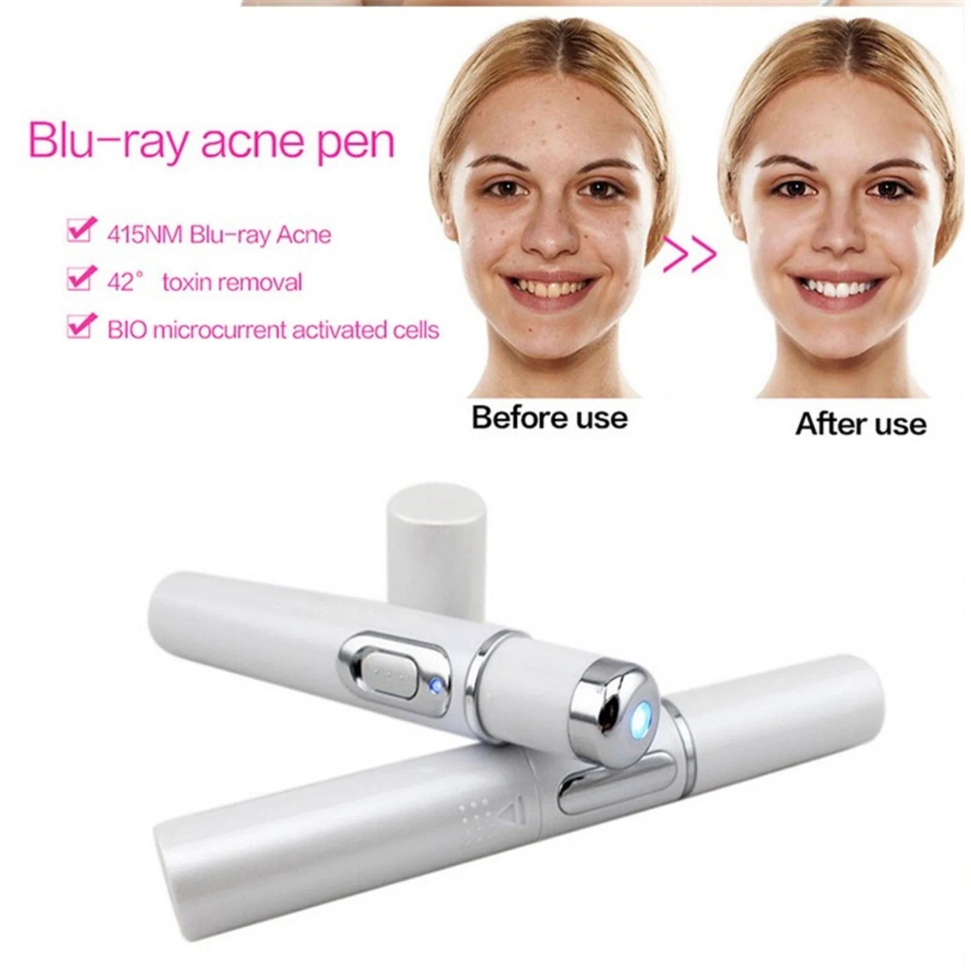 Blue Light Therapy Pen for treating acne, scars, and wrinkles with precise blue light, warming, and microcurrent technology