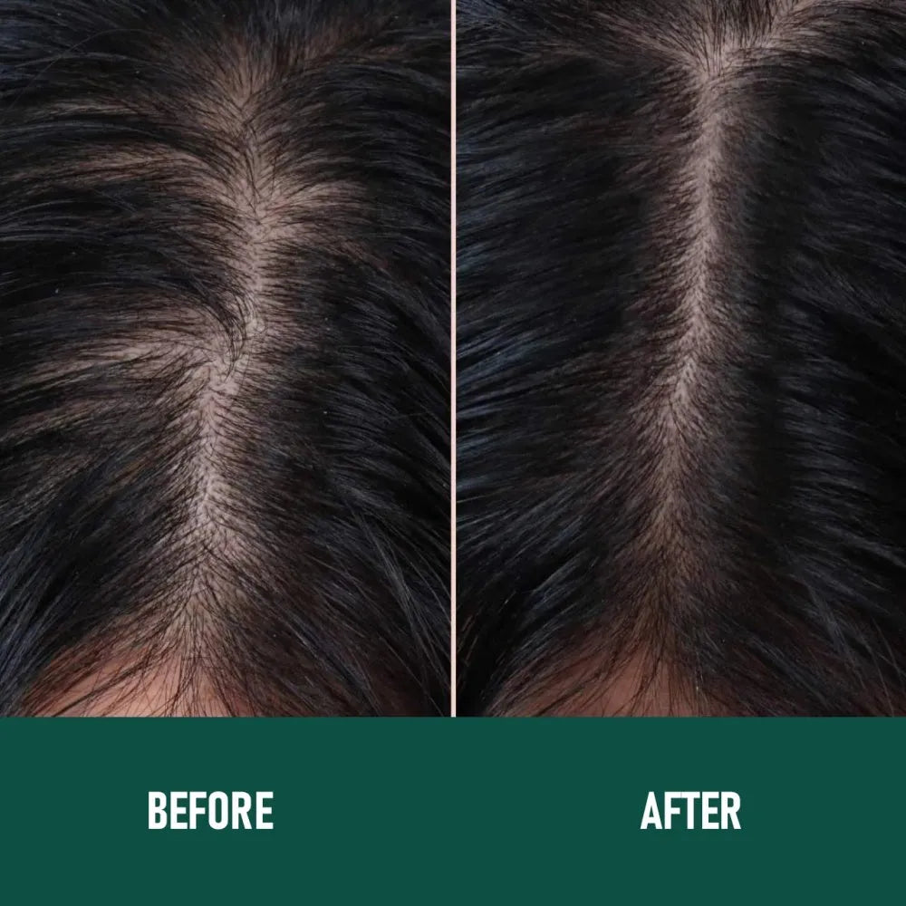 CH004 minoxidil anti-hair loss mousse bottle with applicator nozzle for topical foam treatment