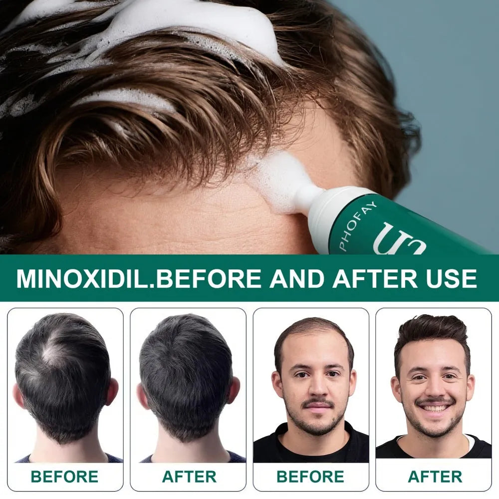 CH004 minoxidil anti-hair loss mousse bottle with applicator nozzle for topical foam treatment
