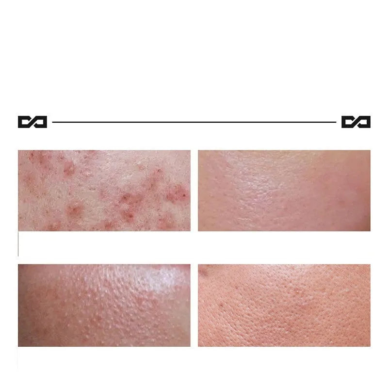 Herbal Lightening Acne Cream 100g tube with niacinamide and salicylic acid for acne-prone skin