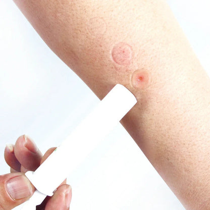 Bug Bite Thing suction tool with reversible cap for insect bite relief