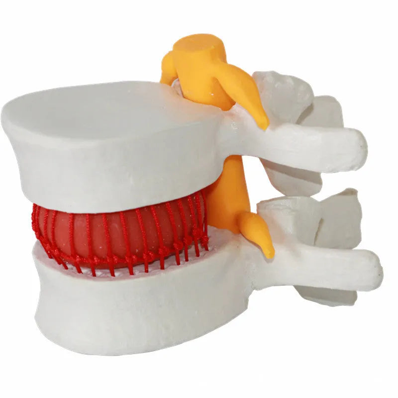 White PVC lumbar intervertebral disc demonstration model for medical education