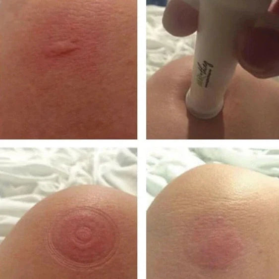 Bug Bite Thing suction tool with reversible cap for insect bite relief