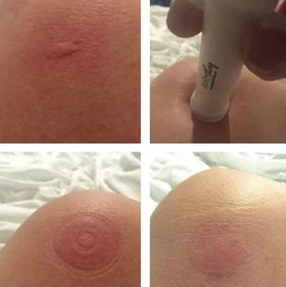 Bug Bite Thing suction tool with reversible cap for insect bite relief