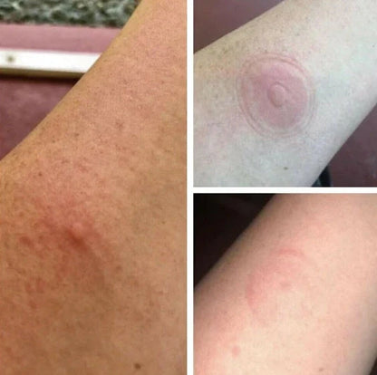 Bug Bite Thing suction tool with reversible cap for insect bite relief