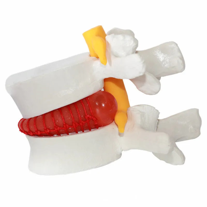 White PVC lumbar intervertebral disc demonstration model for medical education