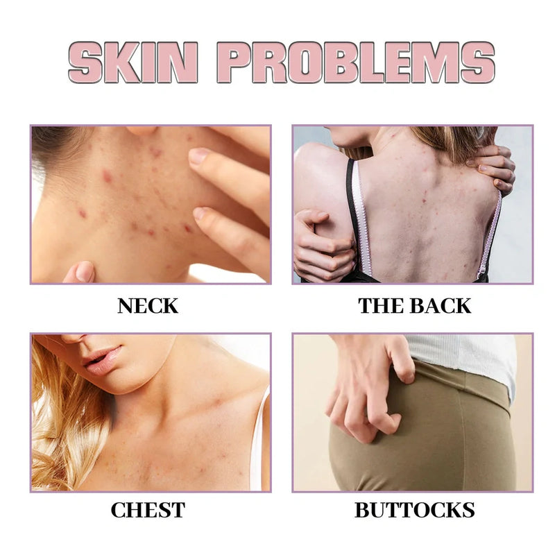 Acne Ball: 30ml chest and back cleansing treatment with vitamin E and tea tree oil to help fade acne, featuring a 13.3cm applicator for precise application on affected skin areas