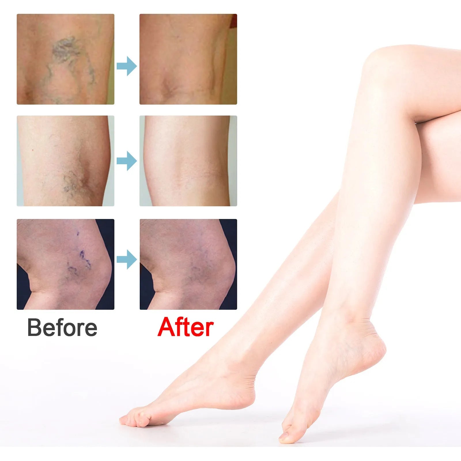 20g tube of vein repair cream for varicose and spider veins on legs