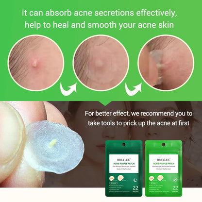 Tea Tree Acne Patch ultra-thin design for fading acne marks and blemishes