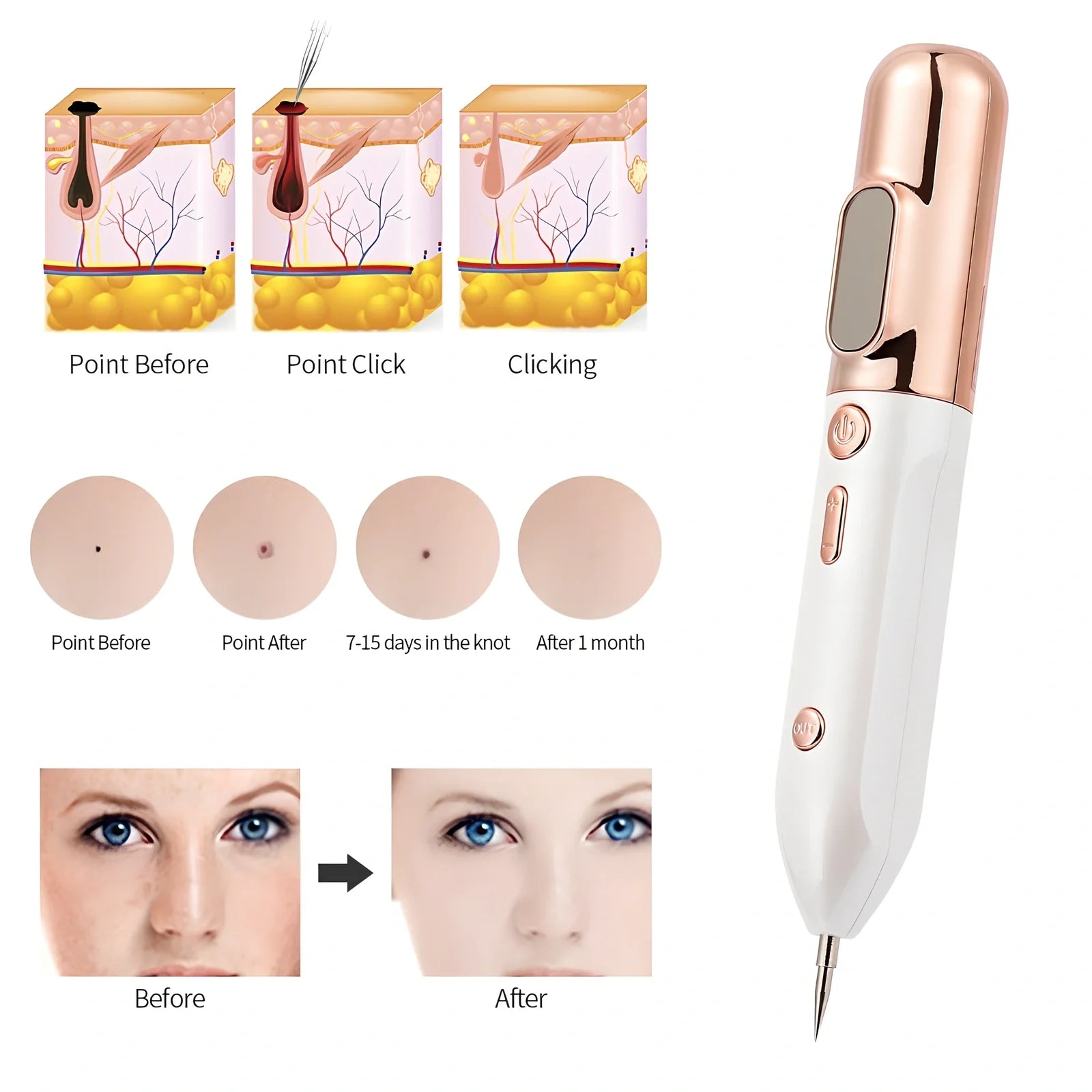 Silver grey Blue Light Acne Beauty Instrument pen with needles, USB, and 5ml cooling gel for spot removal