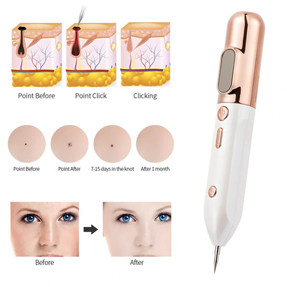 Silver grey Blue Light Acne Beauty Instrument pen with needles, USB, and 5ml cooling gel for spot removal