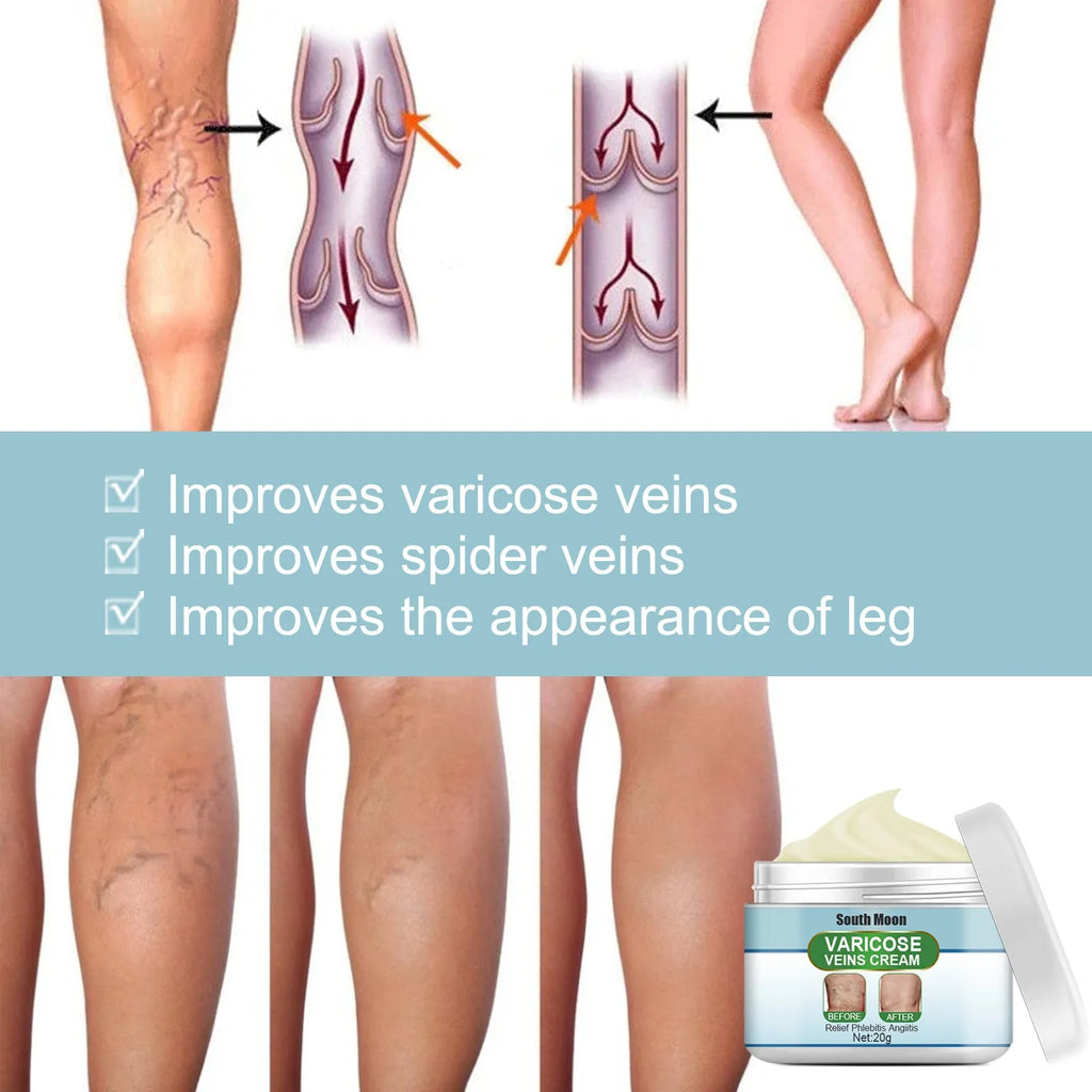 20g tube of vein repair cream for varicose and spider veins on legs