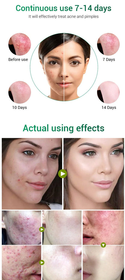 BREYLEE Tea Tree Acne Cream 30g container for acne and scar treatment