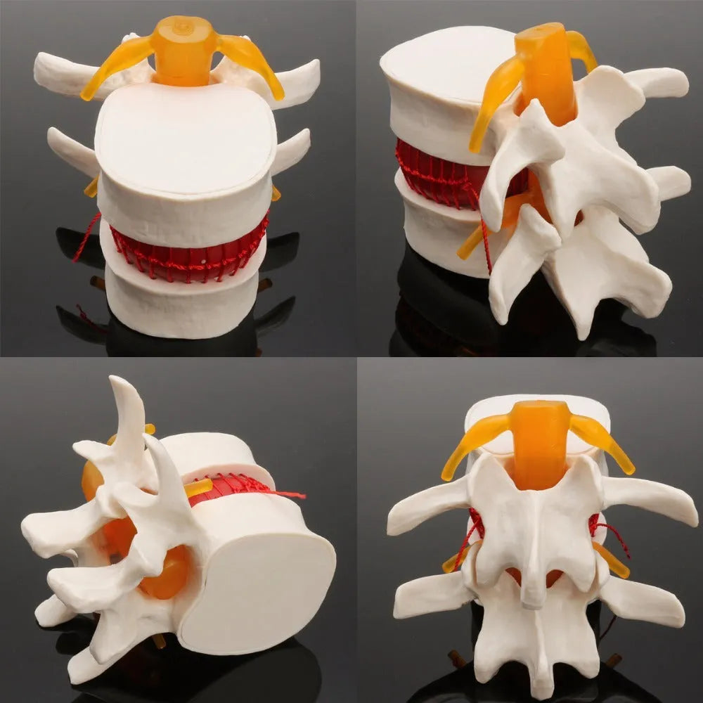 White PVC lumbar intervertebral disc demonstration model for medical education