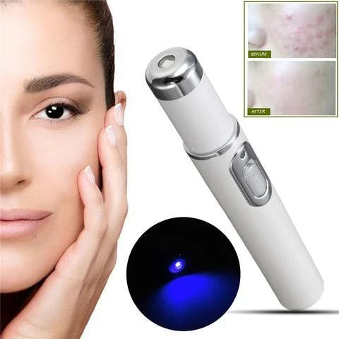 Blue Light Therapy Pen for treating acne, scars, and wrinkles with precise blue light, warming, and microcurrent technology