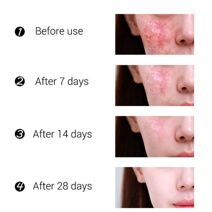 BREYLEE Tea Tree Acne Cream 30g container for acne and scar treatment