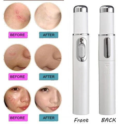 Blue Light Therapy Pen for treating acne, scars, and wrinkles with precise blue light, warming, and microcurrent technology