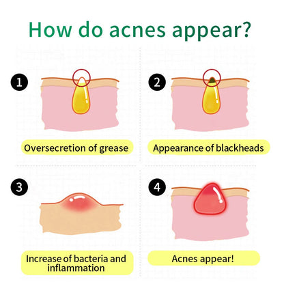 BREYLEE Tea Tree Acne Cream 30g container for acne and scar treatment