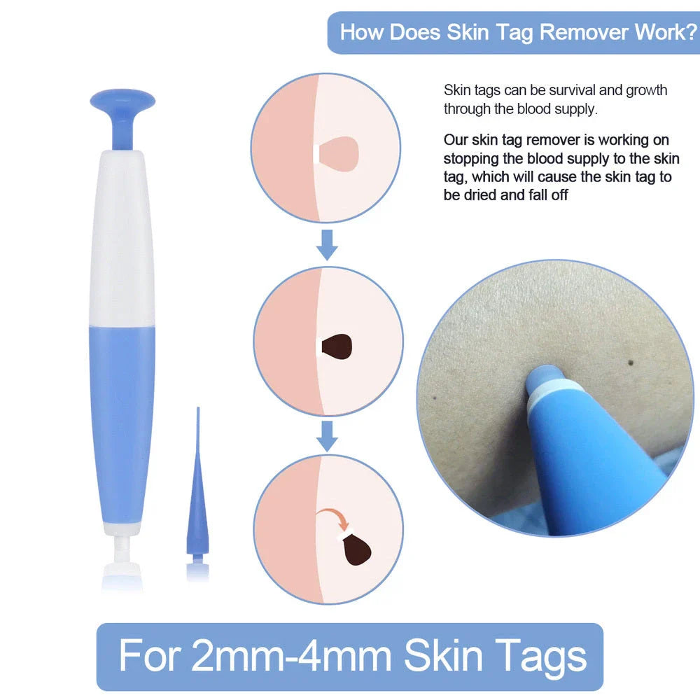 Skin Tag Removal Pen - Safe, Painless and Effective Home Treatment for Removing Moles, Warts, and Skin Tags