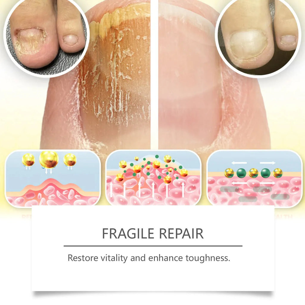 50ml bottle of nail care solution with bee venom and peppermint oil for fungal treatment