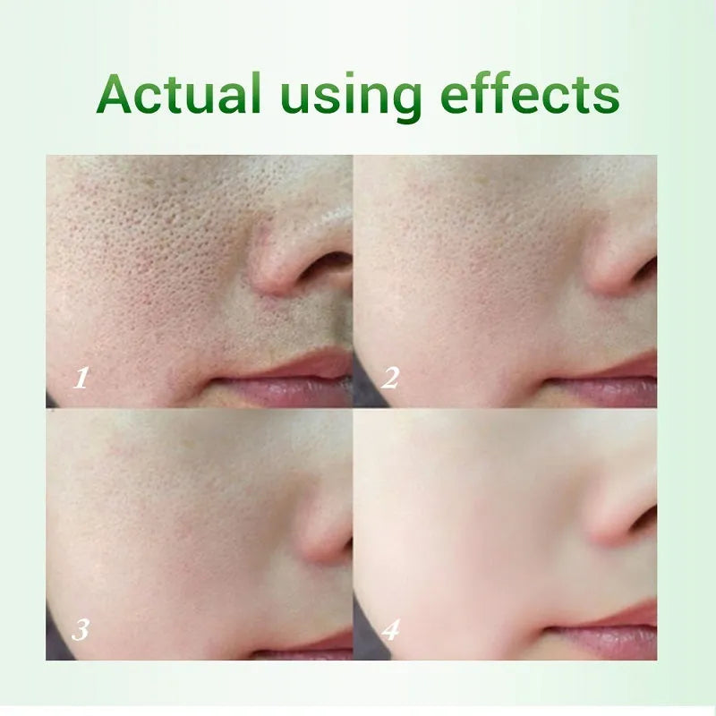 Jar of salicylic acid pore refinement cream 20g for gentle exfoliation and pore reduction