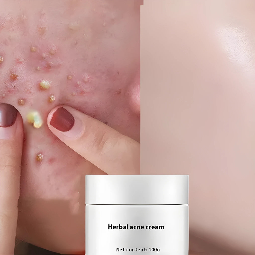 Herbal Lightening Acne Cream 100g tube with niacinamide and salicylic acid for acne-prone skin