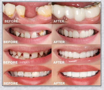 Snap-On Veneers that disguise crooked, stained, and missing teeth for a natural-looking, confidence-boosting smile