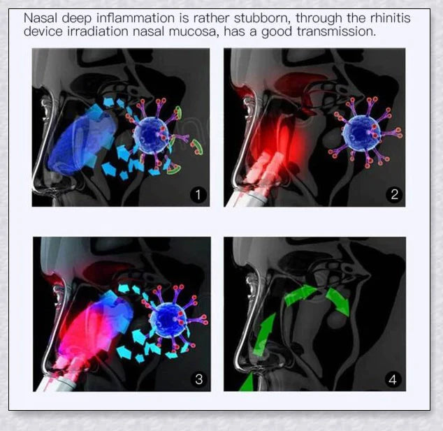 Infrared Rhinitis Therapy Device - Compact, Portable Design for Natural Sinus and Nasal Congestion Relief