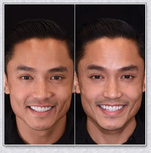 Snap-On Veneers that disguise crooked, stained, and missing teeth for a natural-looking, confidence-boosting smile