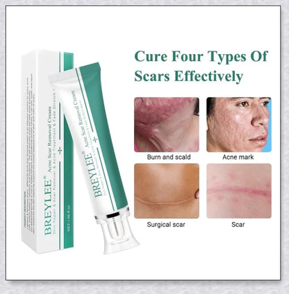 H-Scars Formula - All-Natural Scar Removal Cream for Reducing the Appearance of Scars and Blemishes