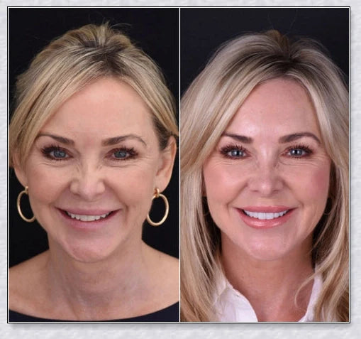 Snap-On Veneers that disguise crooked, stained, and missing teeth for a natural-looking, confidence-boosting smile