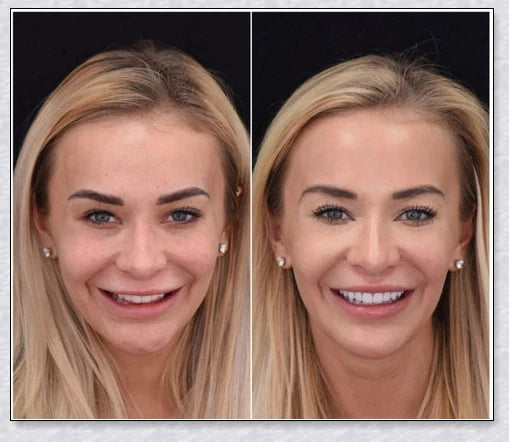 Snap-On Veneers that disguise crooked, stained, and missing teeth for a natural-looking, confidence-boosting smile