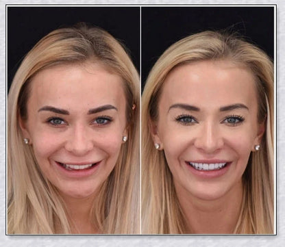 Snap-On Veneers that disguise crooked, stained, and missing teeth for a natural-looking, confidence-boosting smile