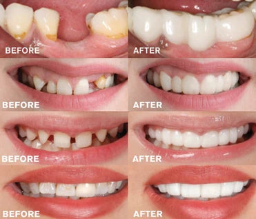 A set of comfortable, natural-looking snap-on dentures that can transform your smile in minutes.