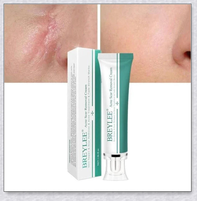 H-Scars Formula - All-Natural Scar Removal Cream for Reducing the Appearance of Scars and Blemishes