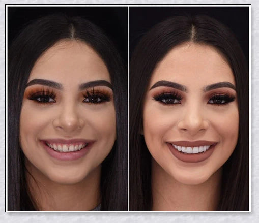 Snap-On Veneers that disguise crooked, stained, and missing teeth for a natural-looking, confidence-boosting smile