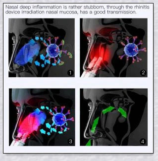 Infrared Rhinitis Therapy Device - Compact, Portable Design for Natural Sinus and Nasal Congestion Relief